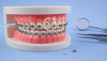 Ligatures élastomériques orthodontie