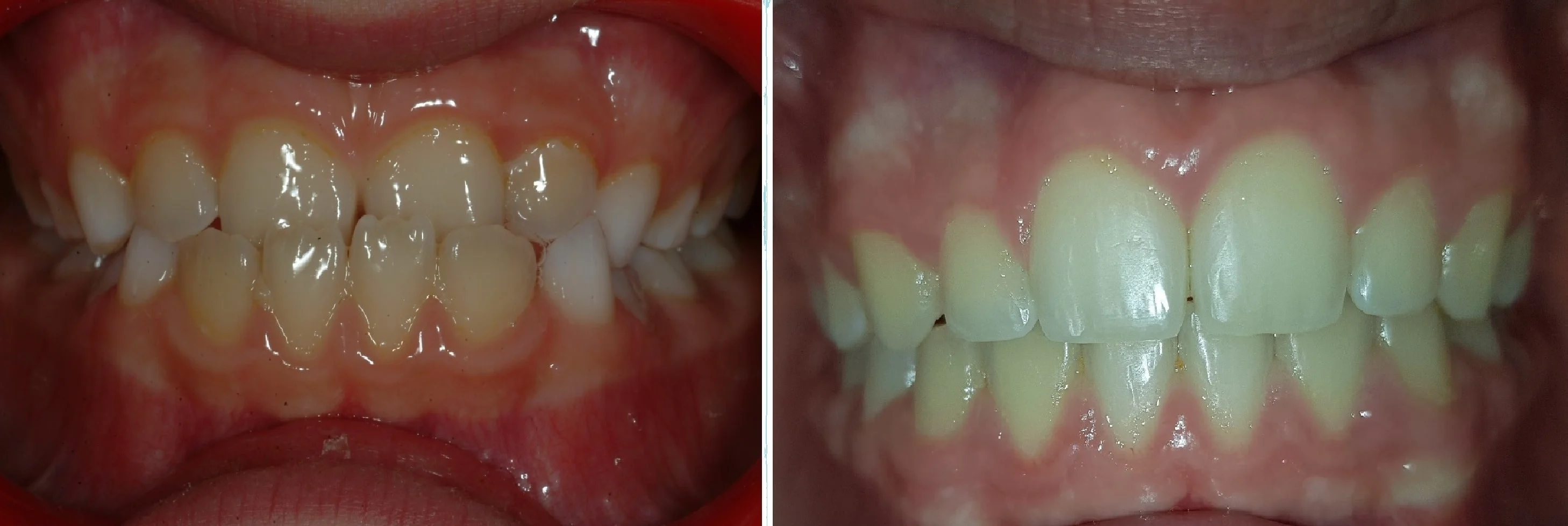 La contention. Après le traitement orthodontique actif - SFODF