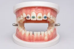 Multi-attaches partiel en denture mixte